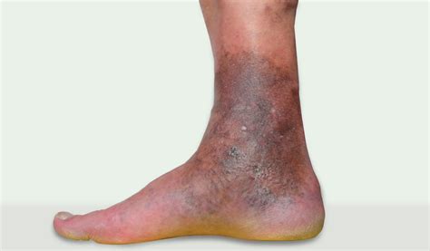 Venous Leg Ulcers Know The Vital Risk Factors Wound Care Surgeons