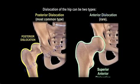 Anterior Vs Posterior Hip Dislocation