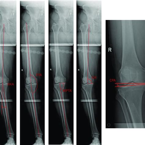 Pre Operative Alignment Measurements On Full Length Radiographs Notes Download Scientific