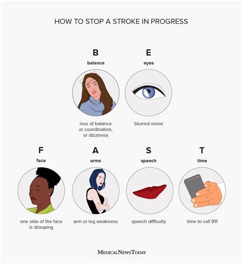 Stroke Face Droop And Paralysis What Stroke Looks Like