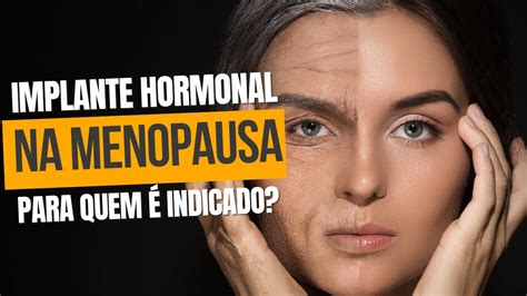 Para Quem Indicado Implante Hormonal Na Menopausa Youtube