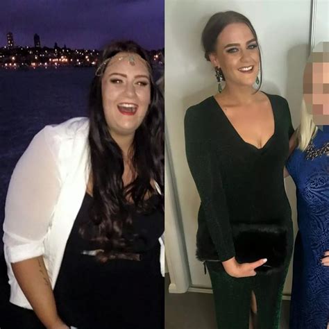 Woman Loses 11 Stone And Has Operation To Have Excess Skin Removed