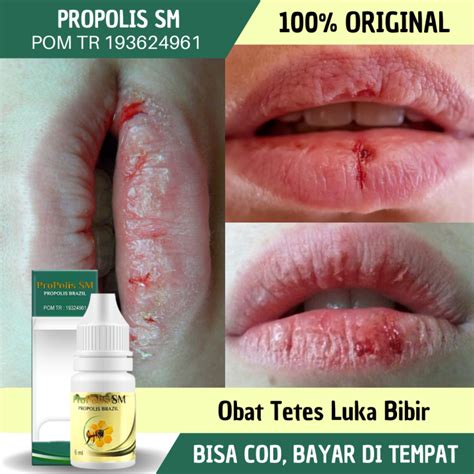 Obat Luka Di Bibir Obat Luka Melepuh Sekitar Bibir Luka Melepuh Benjolan Berair Jerawat