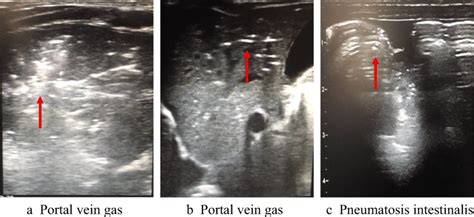 Necrotizing Enterocolitis Ultrasound