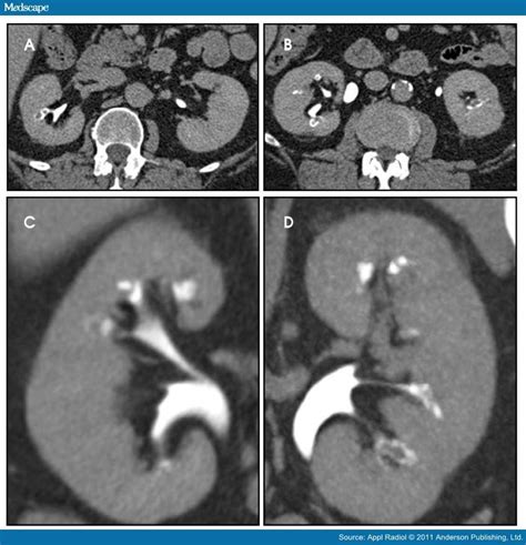 Kidney Papillary Necrosis; Renal Papillitis, Necrotizing