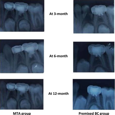 Periapical Radiographs Of The Mandibular Second Primary Molars That