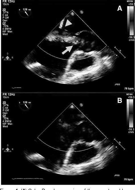 Figure 1 From Left Ventricular Assist Device Related Systolic Aortic Regurgitation Semantic