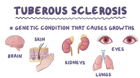 Tuberous sclerosis: Video, Anatomy & Definition | Osmosis