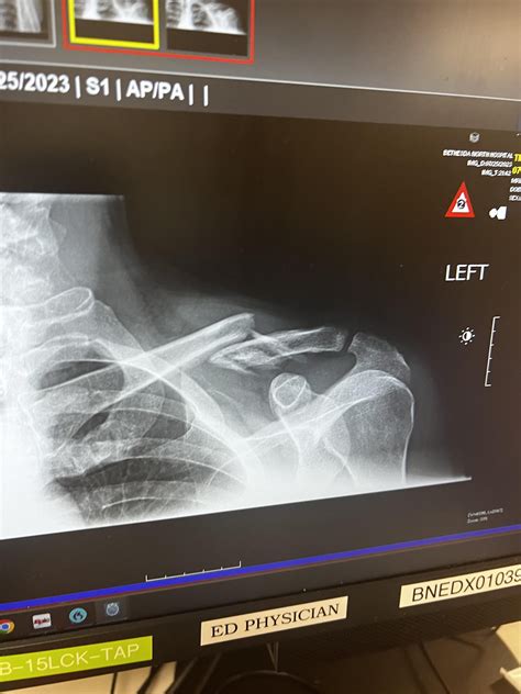 Broken clavicle : r/MedicalGore