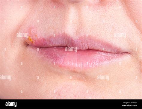 Scabs Stock Photos And Scabs Stock Images Alamy