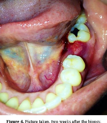 Figure 1 From Intraoral Melanoma Located At The Interproximal