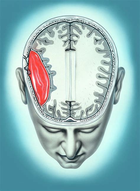 Epidural Haematoma Photograph By John Bavosi Science Photo Library