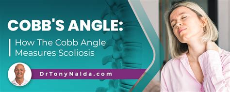 Cobb's Angle: How The Cobb Angle Measures Scoliosis