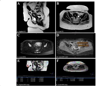 A 54 Year Old Postmenopausal Female Presented By Abnormal Vaginal