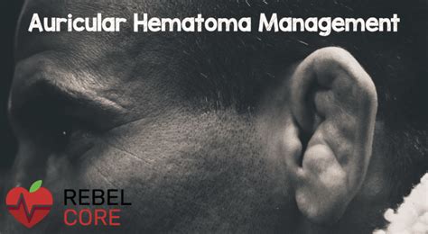 Auricular Hematoma Management Rebel Em Emergency Medicine Blog