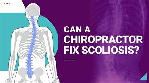 Can A Chiropractor Fix Scoliosis Youtube