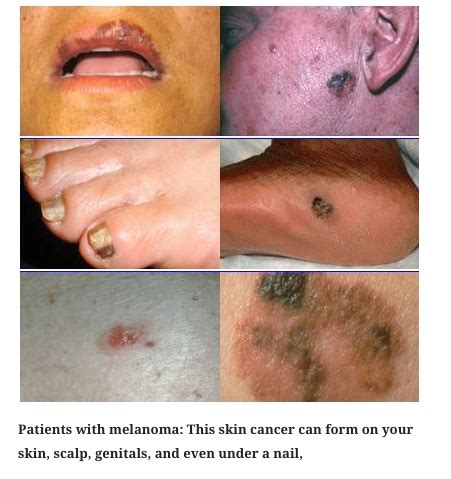 Skin Cancer - Associated Dermatology & Skin Cancer Clinic