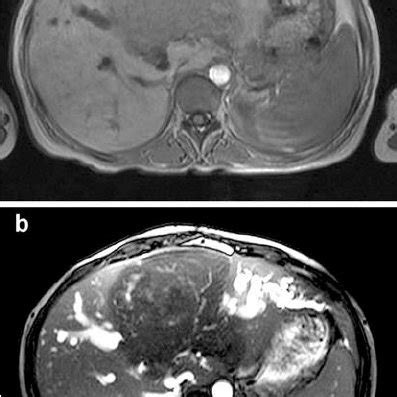 CT Of Hepatic Alveolar Echinococcosis A Unenhanced CT Reveals A