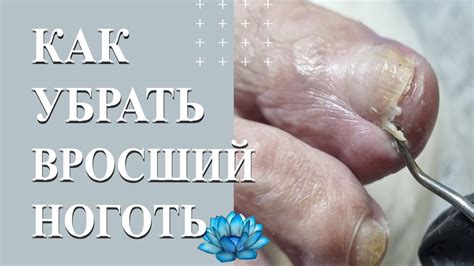Удаление вросшего ногтя. Онихолизис ногтей. - YouTube