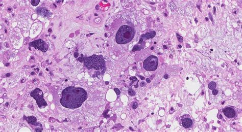 Pleomorphic Liposarcoma Ottawa Atlas Of Pathology