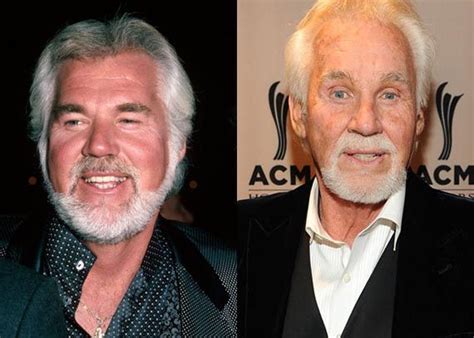 Kenny Rogers Plastic Surgery Before And After Pictures Celebrity