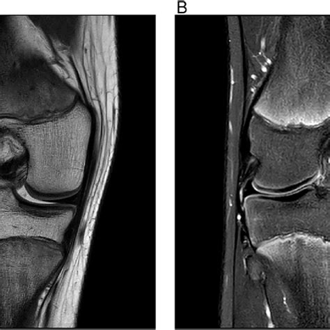 (PDF) Isolated Popliteal Tendon Avulsions: Current understanding and ...