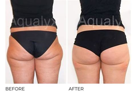 Aqualyx London Fat Dissolving Injections London Cheshire Liverpool