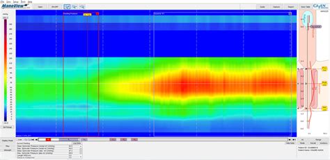 High Resolution Anorectal Manometry Demonstrating Normal Resting And