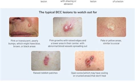 Basal Cell Carcinoma Symptoms Types And Pictures – Otosection