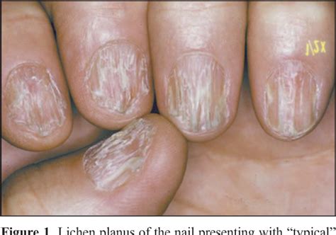 Lichen Planus Nails Treatment - Captions Entry