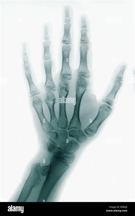 Hand bones X-ray Stock Photo - Alamy