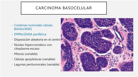 Carcinoma Basocelular Espinocelular Y Su Tratamiento Ppt