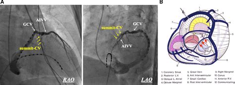 Idiopathic Ventricular Arrhythmias Originating From The Vicinity Of The