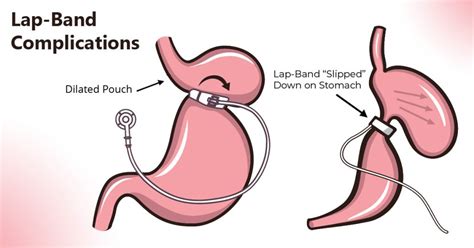 Lap-Band Complications - SLIMMS WEIGHT LOSS