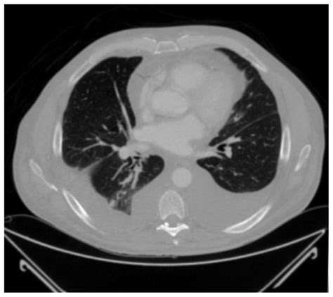 Ct Chest Showing Bilateral Pleural Effusions And Clear Lung Parenchyma