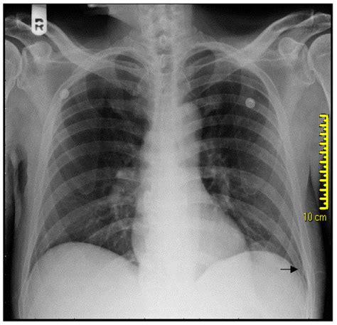 Xray Of Broken Ribs