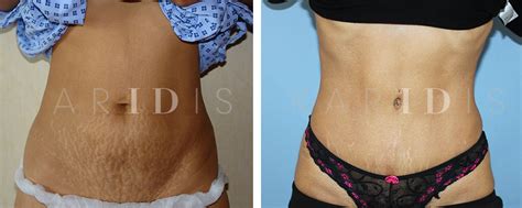 Mini Tummy Tuck Before And After