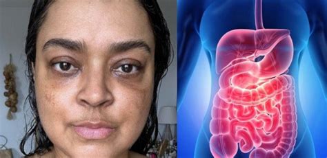 C Ncer De Preta Gil Como Preta Gil Descobriu Um C Ncer No Intestino