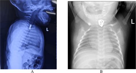 A And B Chest X Ray Show The Foreign Body At The Level Of The Th