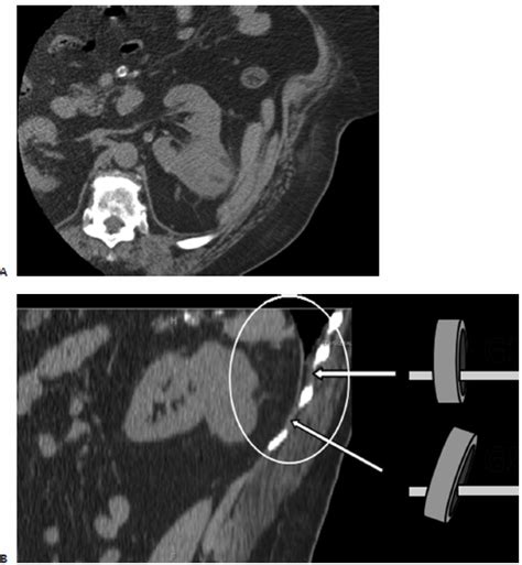 7 Kidney Ablation Radiology Key