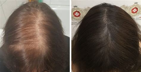 La Micropigmentation Capillaire Chez Les Femmes Scalp Swiss