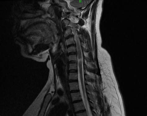 Mri Cervical Spine Teleradwin