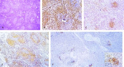 Follicular T cell lymphoma: (A) Follicular pattern of involvement of... | Download Scientific ...