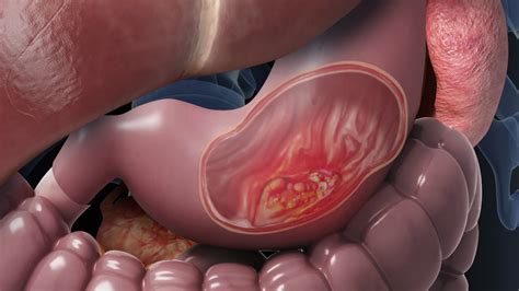 Gastric Carcinoma Stomach Cancer Cancer Stomach Types Stomach