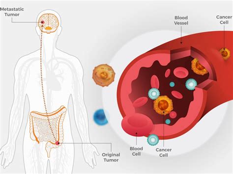 Metastasis- All You Need To Know