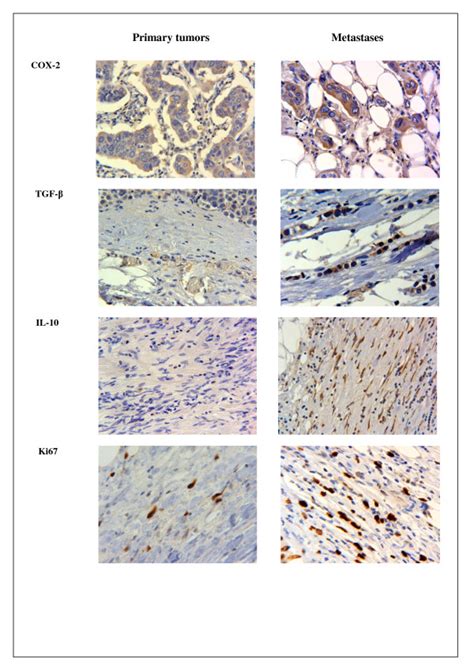 Expression Of Cox 2 Tgf β Il 10 And Ki67 In Tumor Cells And Stromal Download Scientific