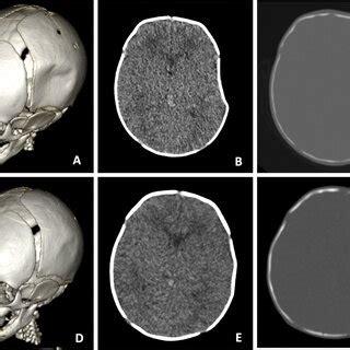 Treatment Of Depressed Skull Fractures With Vacuum Devices In The