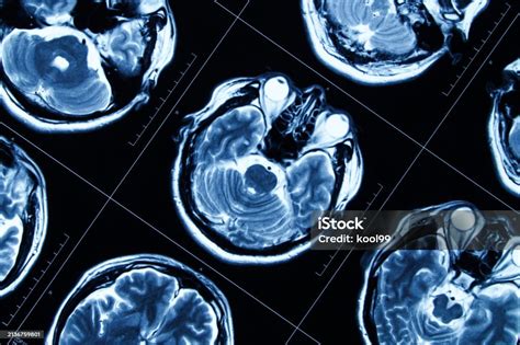 Mri Scan Human Head Tomography Stock Photo - Download Image Now - Brain ...