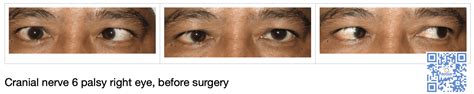 Cranial Nerve Palsy | 3rd nerve palsy | 4th nerve palsy | 6th nerve palsy