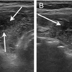 (PDF) Heterogeneous echogenicity of the underlying thyroid parenchyma ...